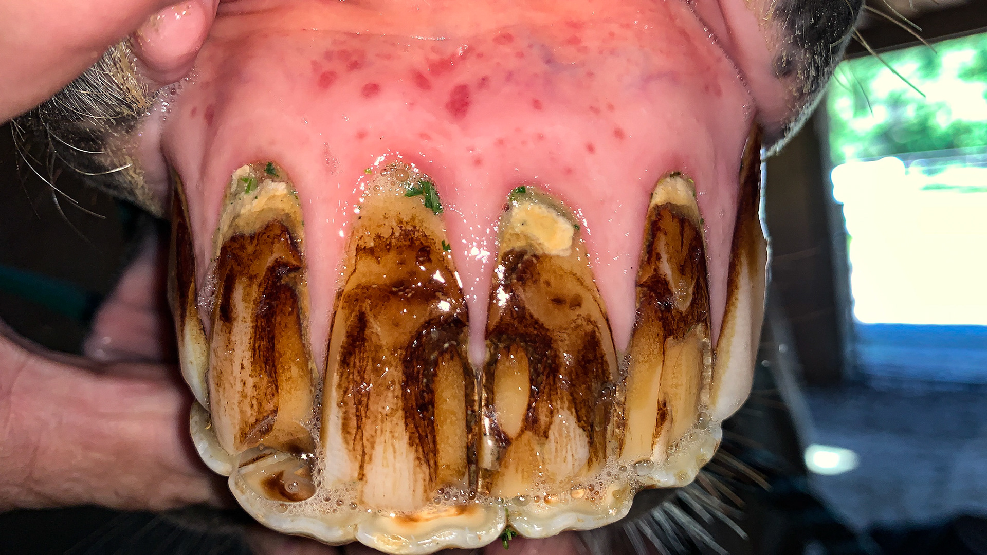 Receding gum line on the upper incisors with hypertrophy (enlarged and thickened edge)and inflammation (dark red spots) of the gums and tarter on the teeth.
