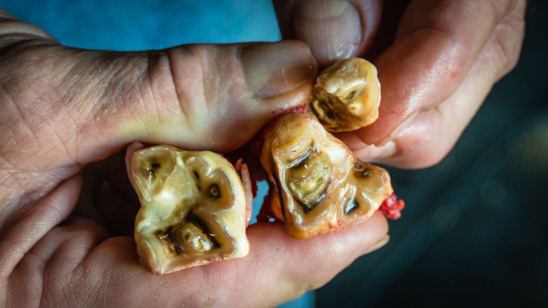 Cheek teeth fracture horse 1 -Fractured piece of 108 on caudal buccal surface was extracted. The remaining tooth and the neighboring 107 were unstable due to age (27 yr, end stage teeth) and were also removed with little effort.