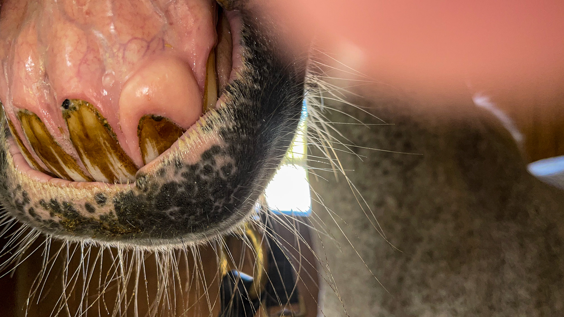 EOTRH with receding and hypertrophied gums.