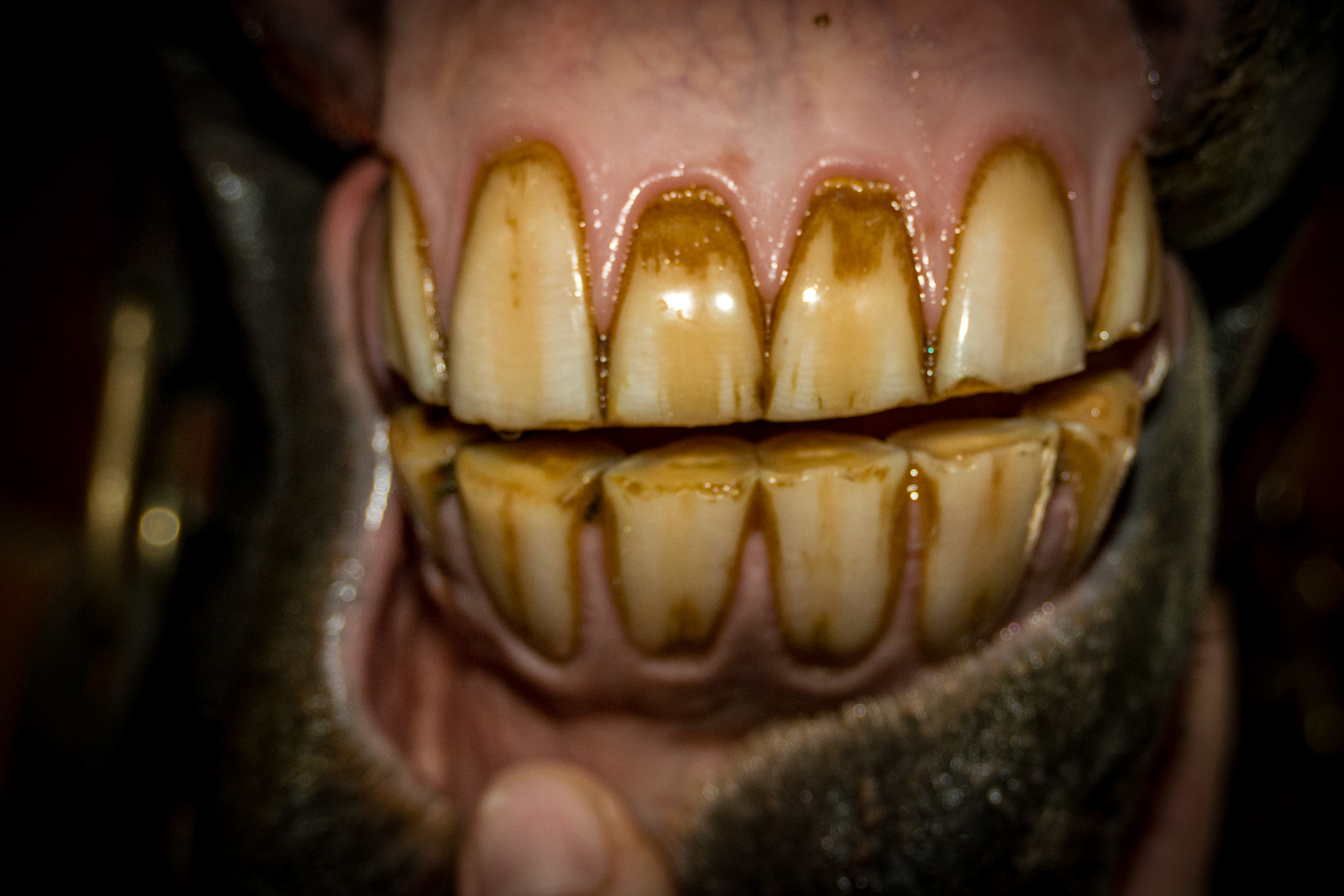 21yr 2mo - with relaxed incisors in a natural position