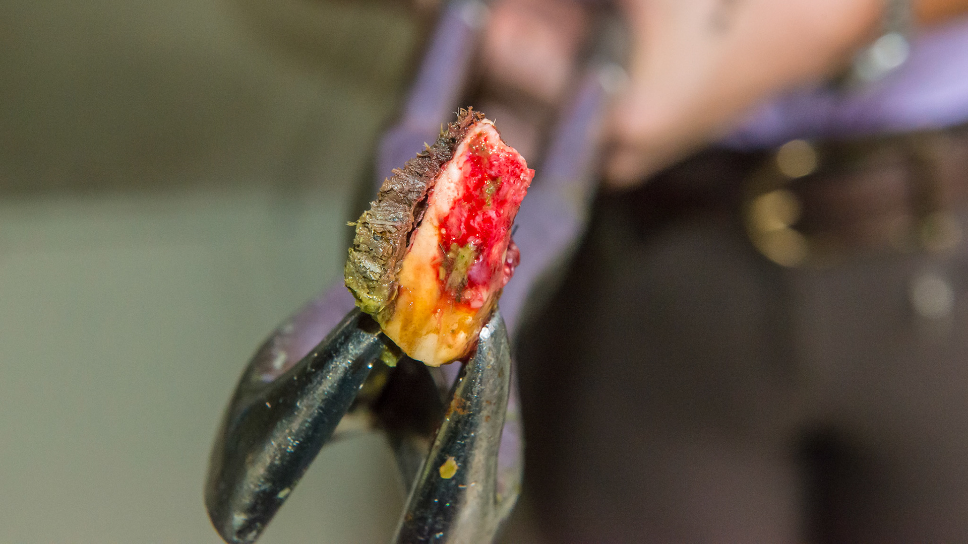 #408 lingual saggital fractured piece with associated feed wedged in between the fractured piece and the remaining tooth. Easily extracted with forceps leaving a deep socket. This is the 4th cheek tooth fracture in this horse in about a year.