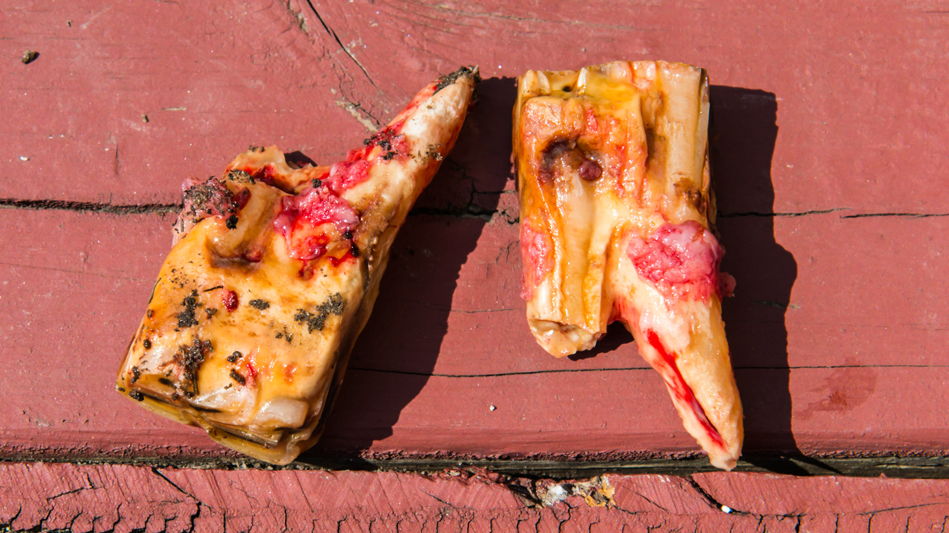 308 and 408 in a 22 year old mare.  These teeth tilted laterally into the cheeks with packed hay.  The tongue was unable to clean the areas.  There was a malodor of decay in both teeth and both were loose and painful.  Extractions were simple with IV pain medication.  Both teeth had broken roots that had fractured in the past.  The remaining roots were left where they were and the horse was given 3 days of Uniprim.