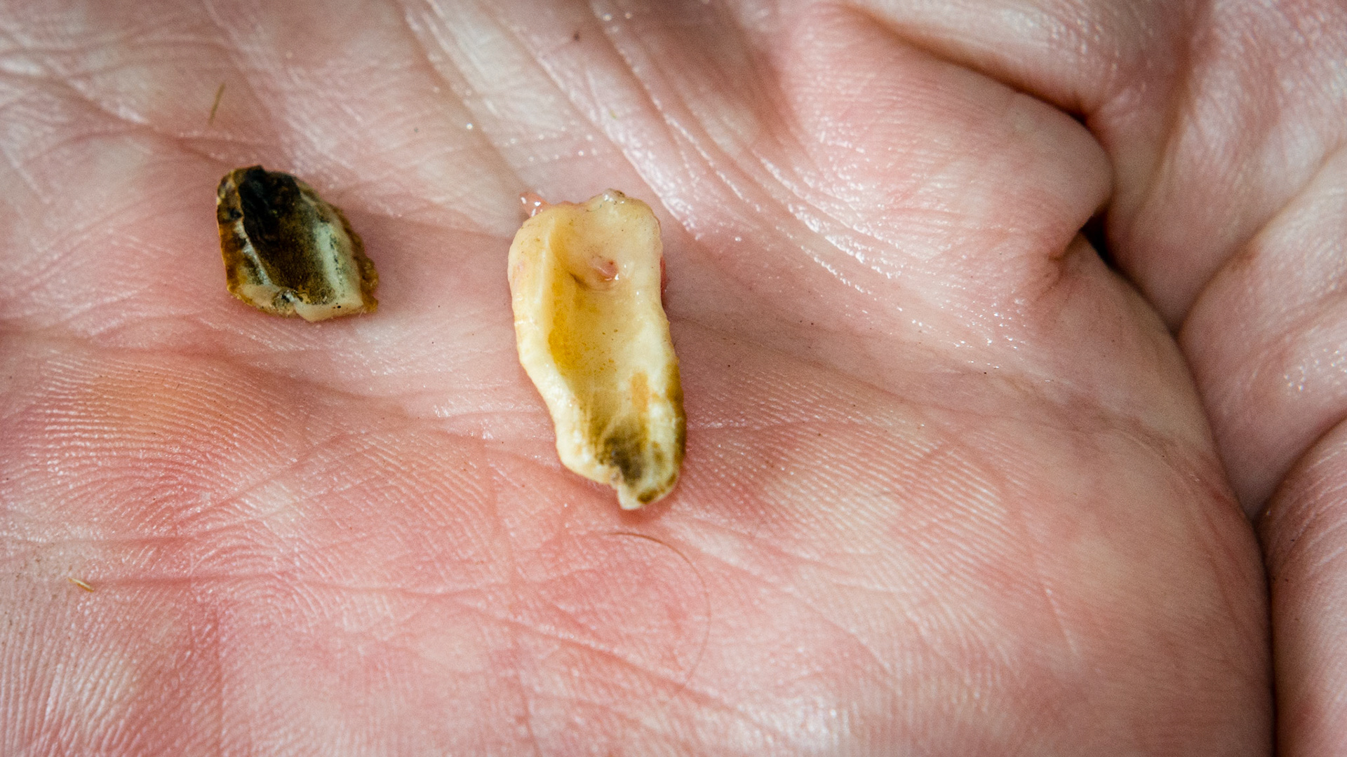 Incisor cap remnant horse 7 - 72 and 82 cap remnants in a 17 year old. Malodor but not painful. Removed without drugs using a wolf tooth elevator.