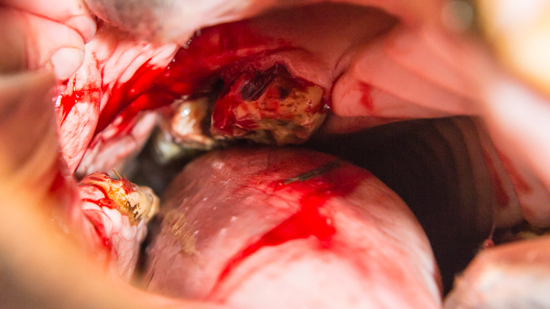 Cheek teeth fracture horse 8 -Extraction of fractured piece from buccal 107 with associated buccal ulcer.  The fractured piece removed.  The blood is from the attached gum to the fractured piece.