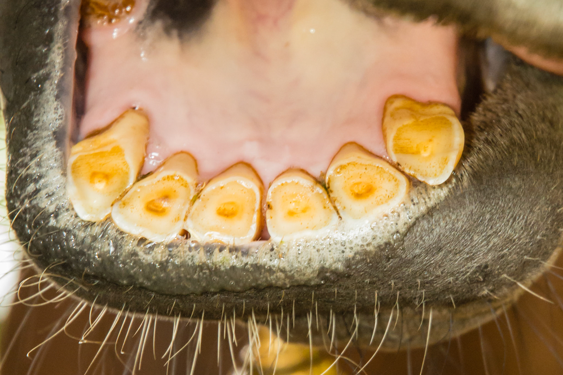 19yr 3mo - Bells palsy - tongue protrudes on right side and teeth are slightly out of alignment.