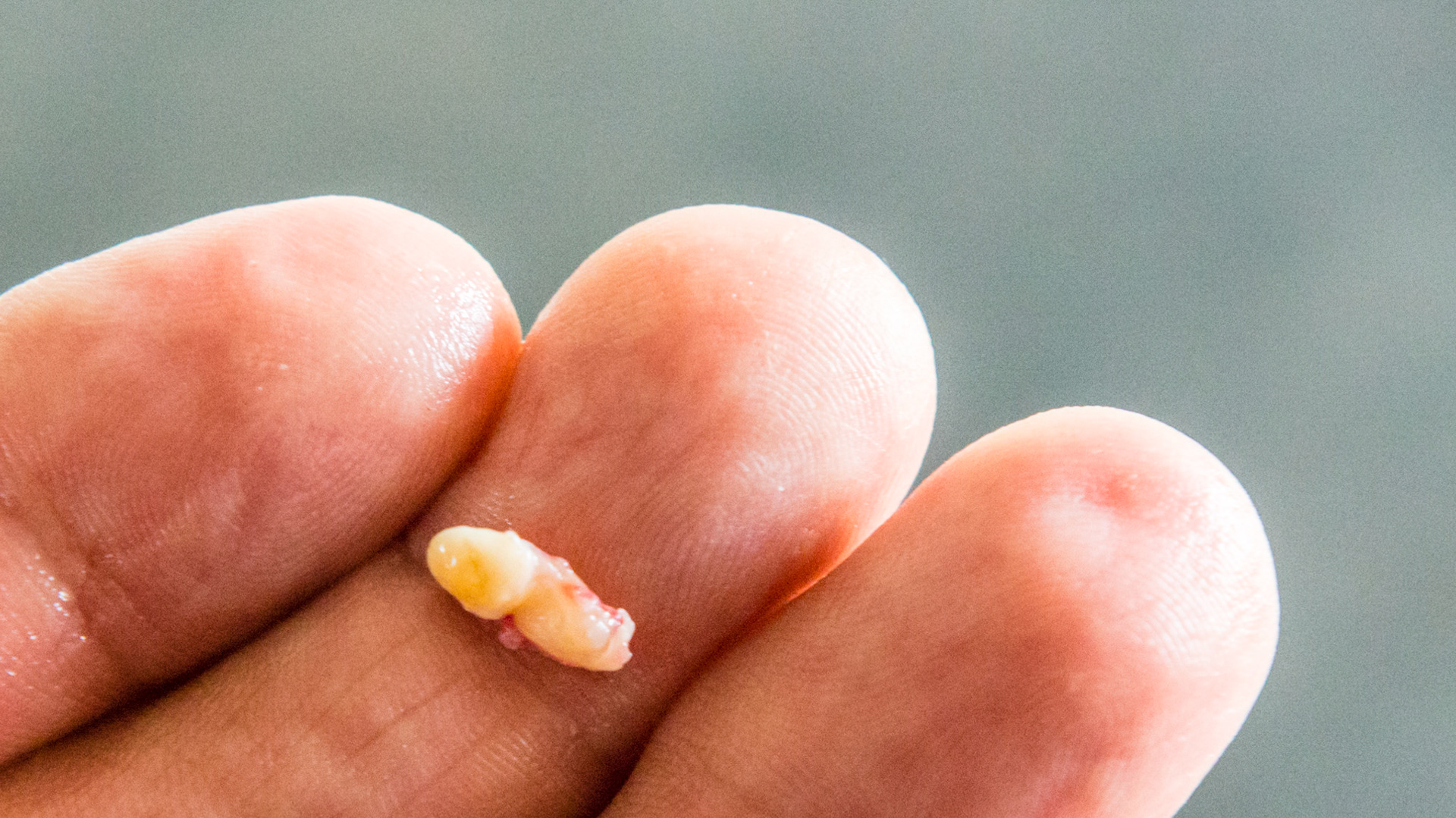 Wolf tooth #305 on the medial side of 306 - removed - 1 of 3 views.