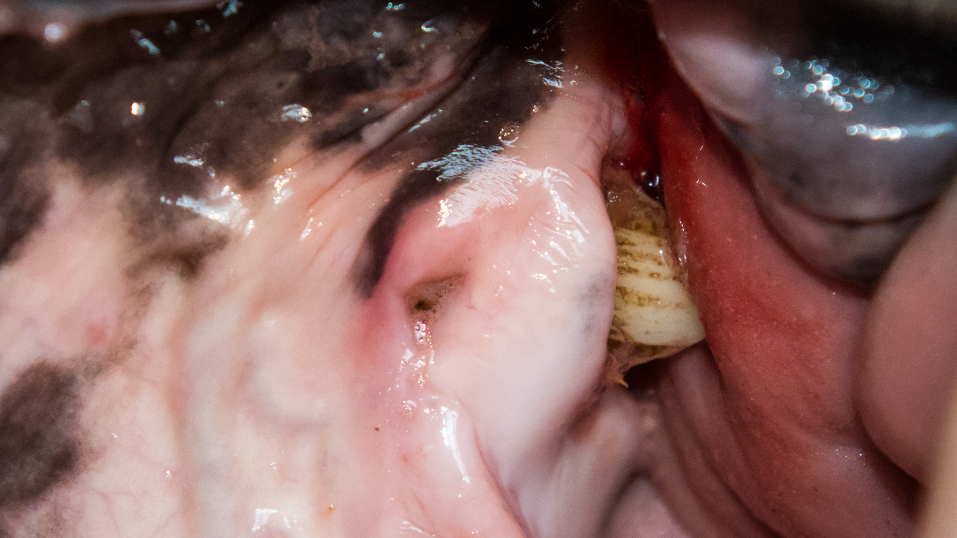 Hole - Small hole in gum above #205 where a foreign object was palpated.  It was non-painful.