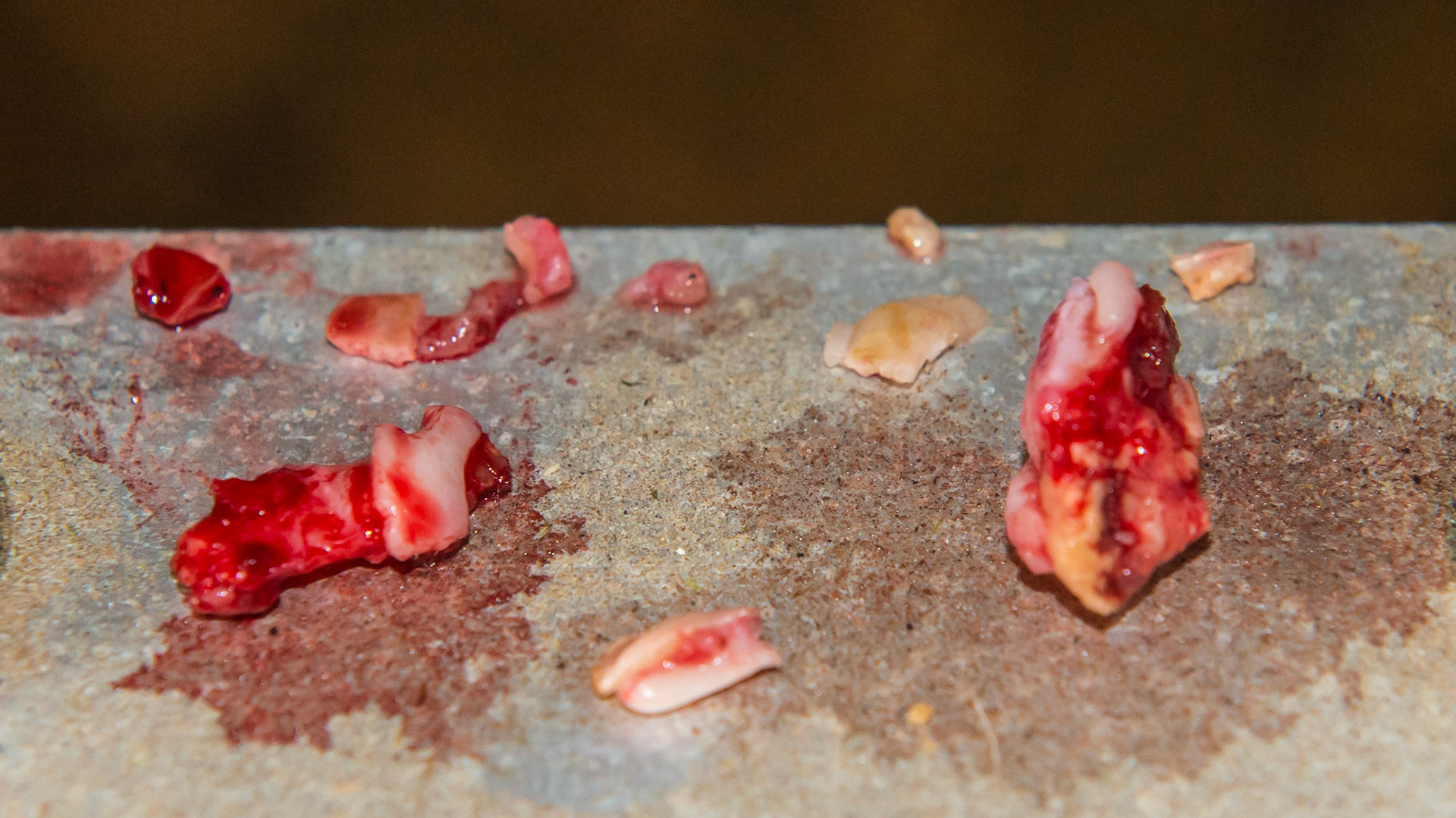 EOTRH horse 17 - #301 coronal fracture due to EOTRH with tooth fragments remaining. All of the disintegrated pieces of socket and tooth that were removed from #301.