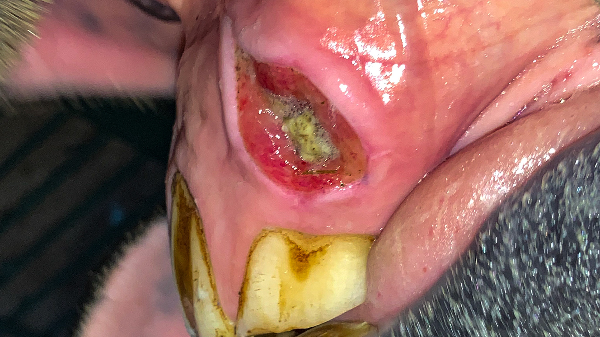 This was an incidental finding during routine floating.  The thickening of the tissue and margins of this gum wound indicates that this is a few days old. While there is debris in the wound there is no indication of infection as it is bathed in saliva with antibodies.  I presume that this will heal without problems.  The horse had no difficulty chewing.