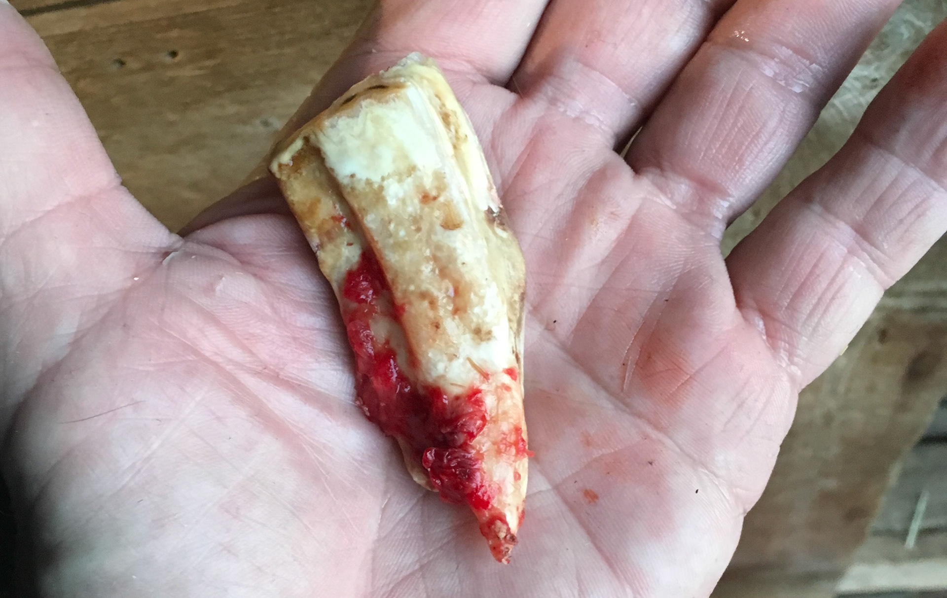 Large cheek tooth fracture shows the black decay that caused the saggital split.