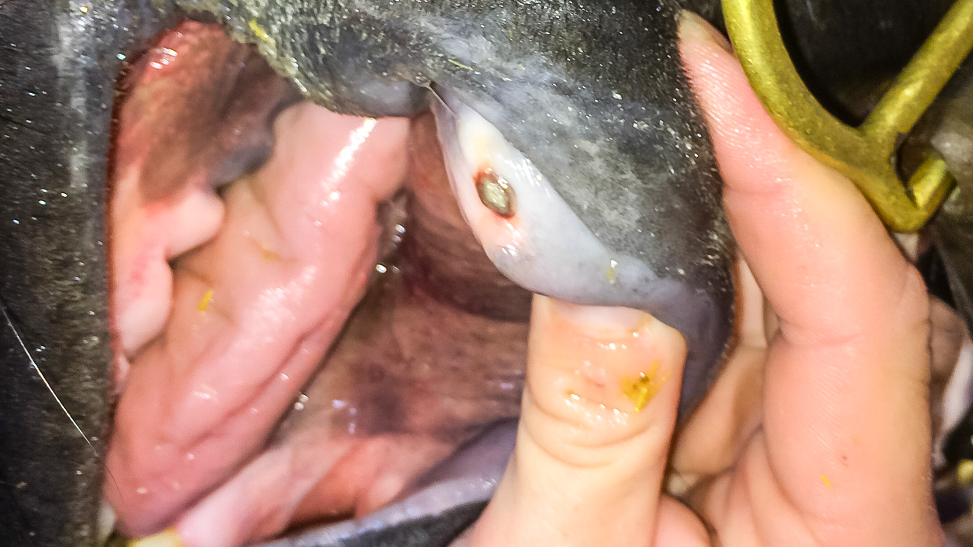 Lip bite of many days duration.