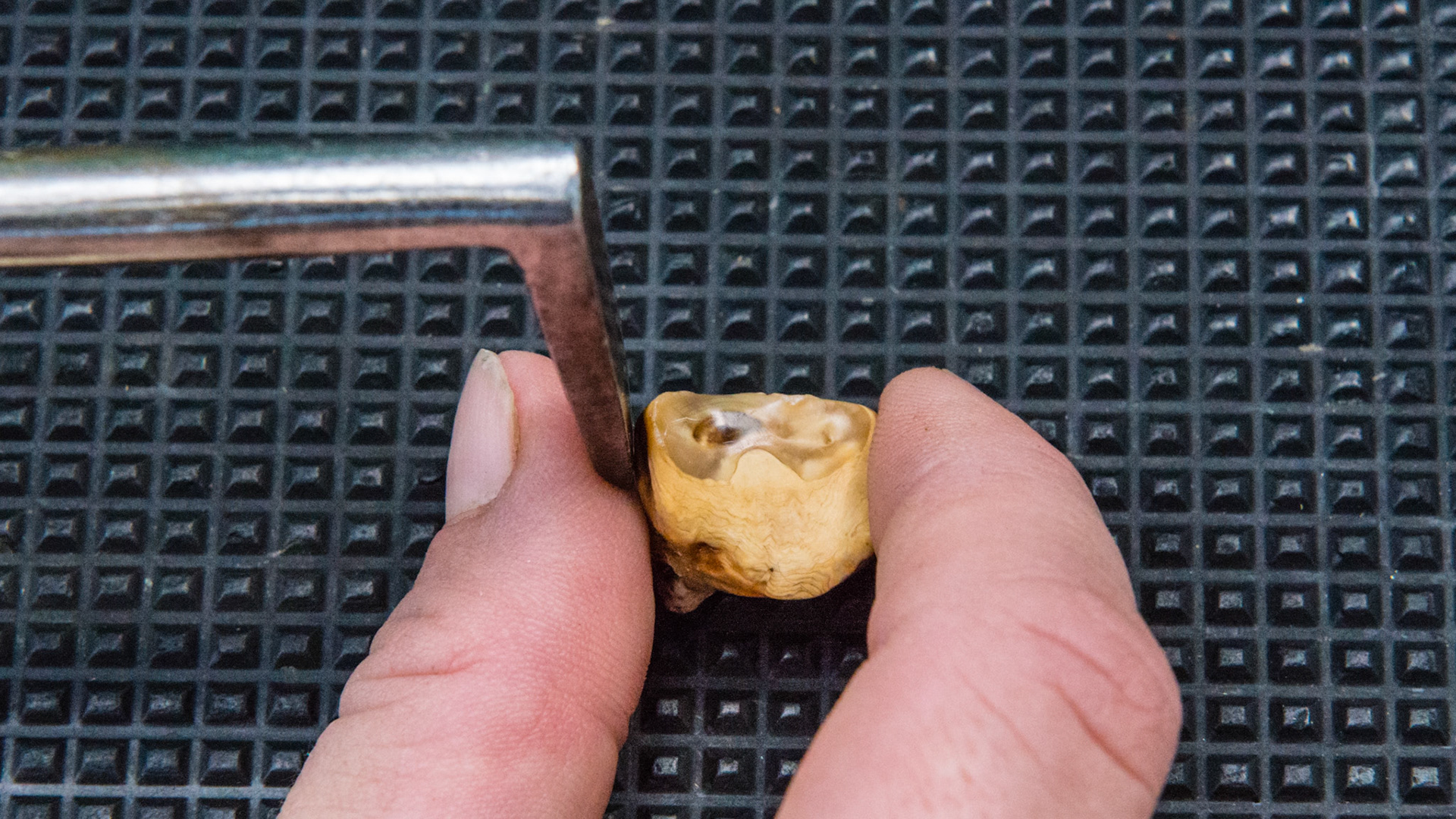 408 medial sagittal and transverse tooth fragment in a 28 year old. The lingual side faces the hand. The dental pic was placed between 407 (the thumb) and the tooth fragment. Pressing caudally, the fragment was displaced medially and was then grabbed with the fingers.