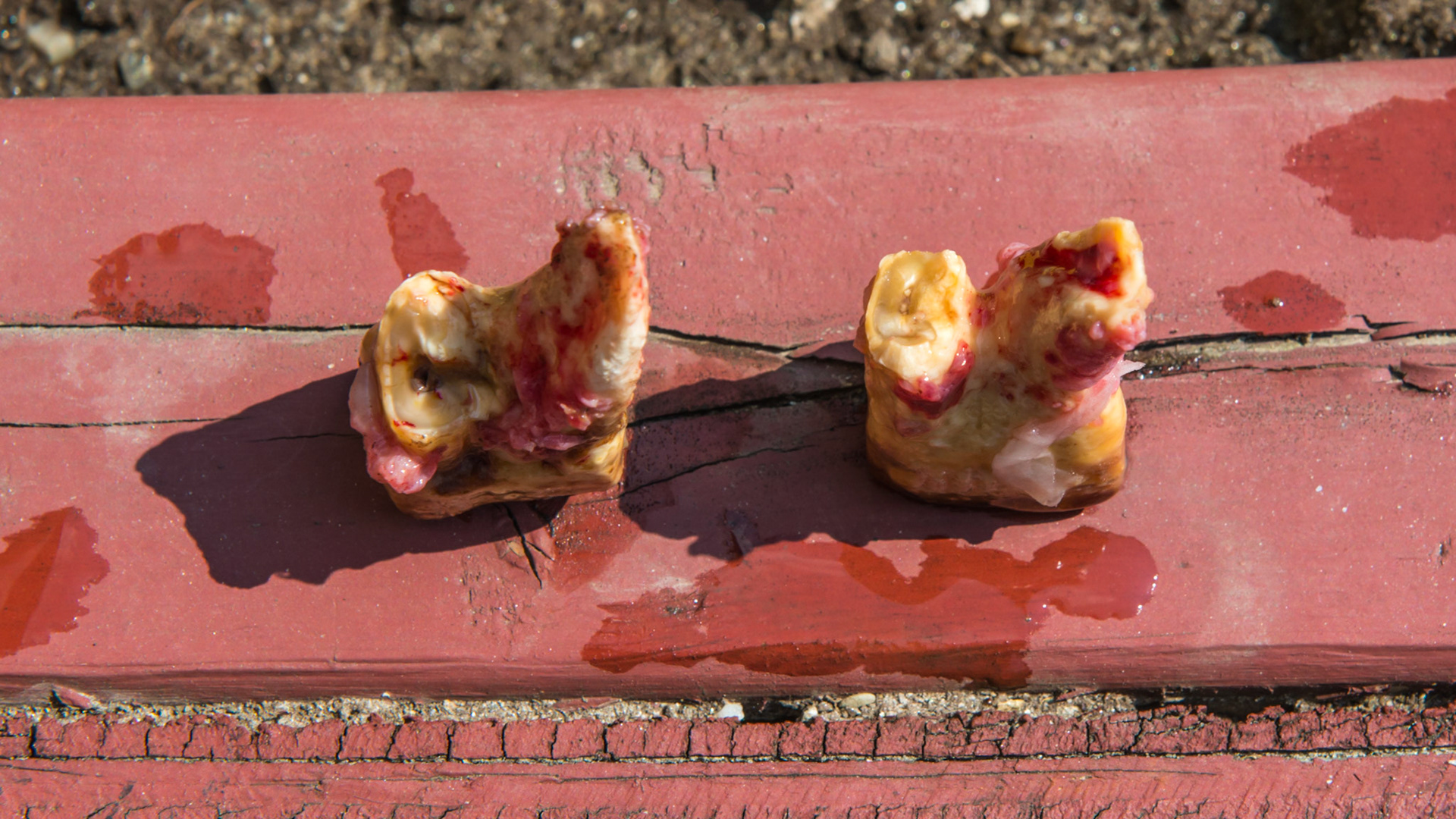 308 and 408 in a 22 year old mare.  These teeth tilted laterally into the cheeks with packed hay.  The tongue was unable to clean the areas.  There was a malodor of decay in both teeth and both were loose and painful.  Extractions were simple with IV pain medication.  Both teeth had broken roots that had fractured in the past.  The remaining roots were left where they were and the horse was given 3 days of Uniprim.