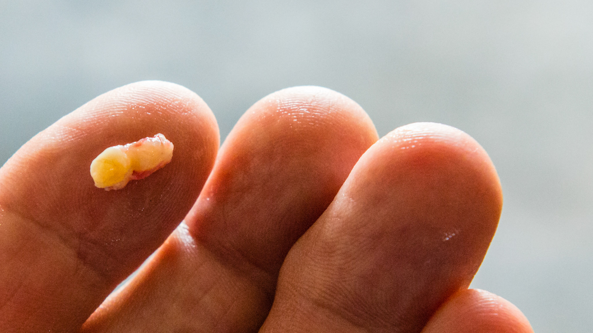 Wolf tooth #305 on the medial side of 306 - removed - 1 of 3 views.