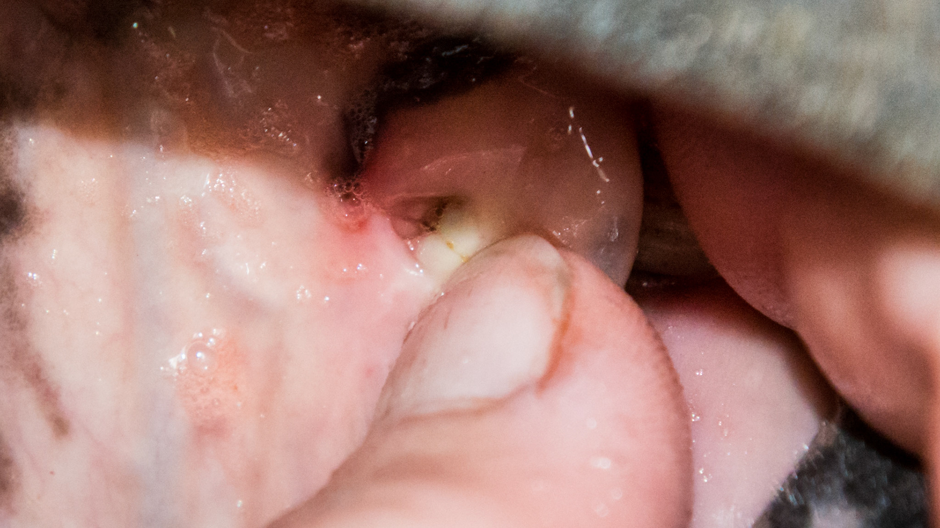 Hole - Small hole in gum above #205 where a foreign object was palpated.  It was non-painful. Here the finger is opening the hole.