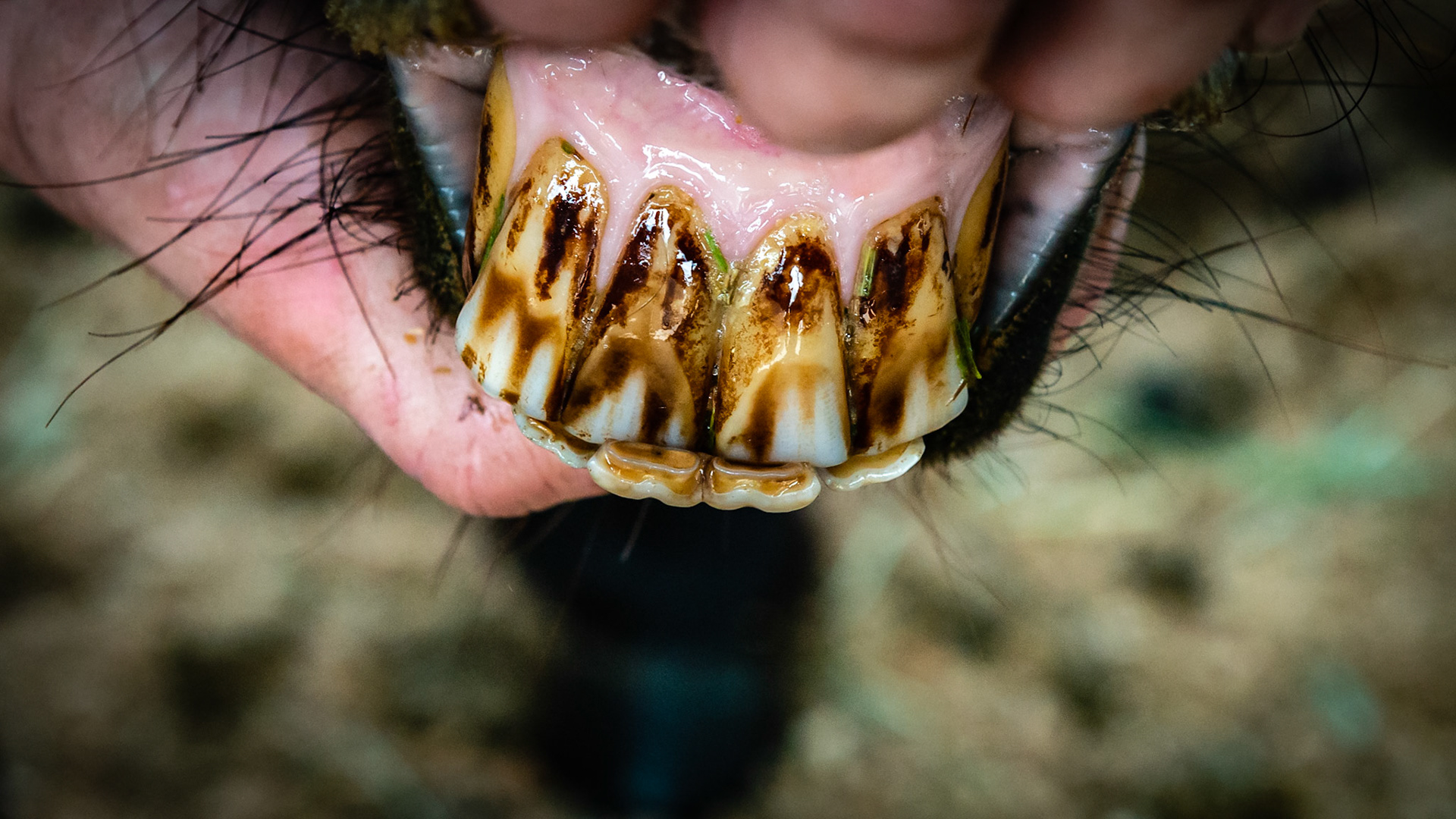 301 and 302 are over erupted and wear on the labial surface of the opposing upper incisors.