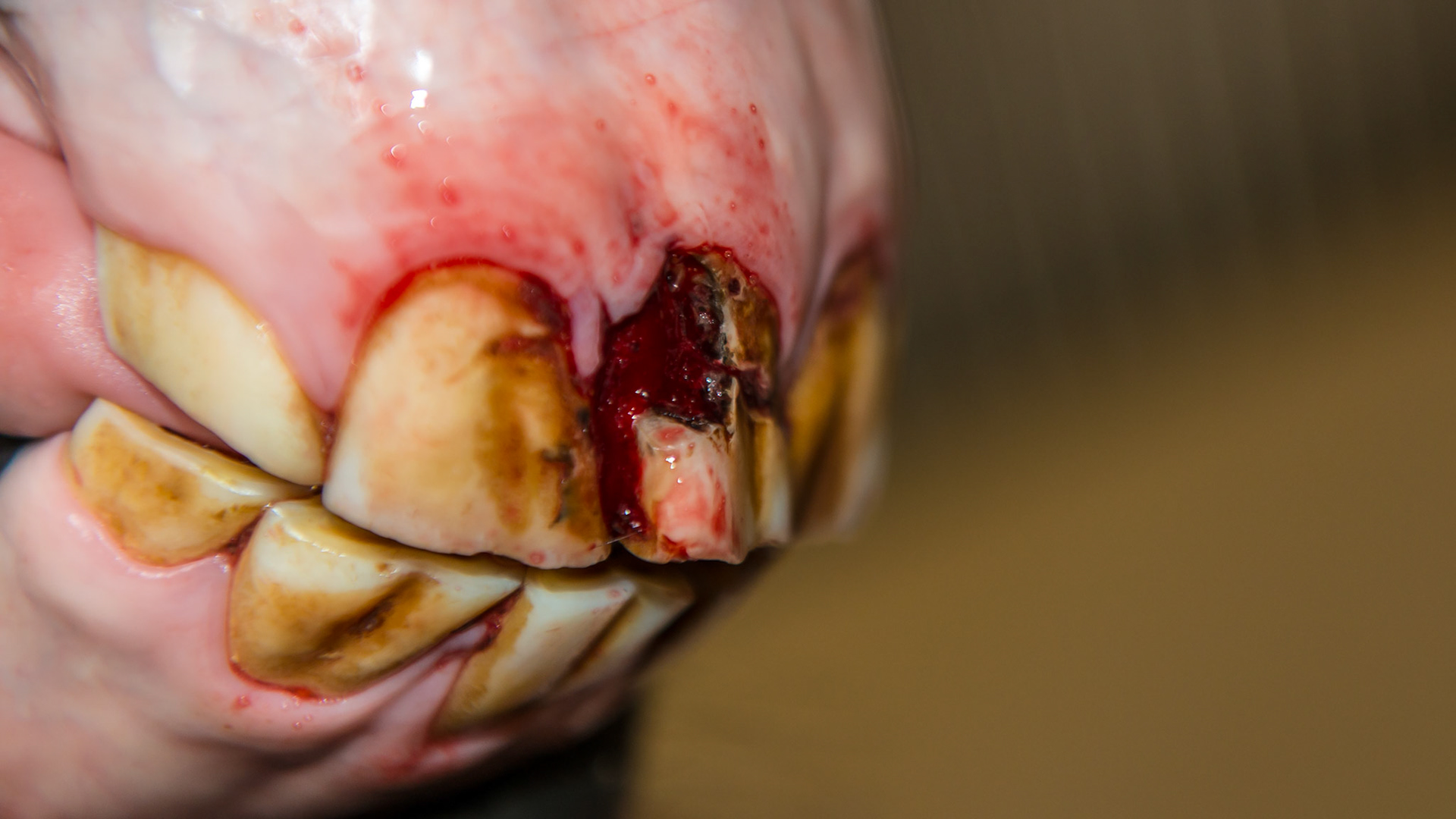 Possible trauma form some point in the past in this recently purchased 6 year old horse that has damaged 101. The missing part of this tooth was just extracted and the clump of malodorous impacted food has been removed.  There is a crack seen on ther rostral-medial surface of this tooth.  The distal part of 101 has movement and is separate from the remaining 101 tooth.  The owner elected to keep the tooth in place and I will be watching it as time moves forward.