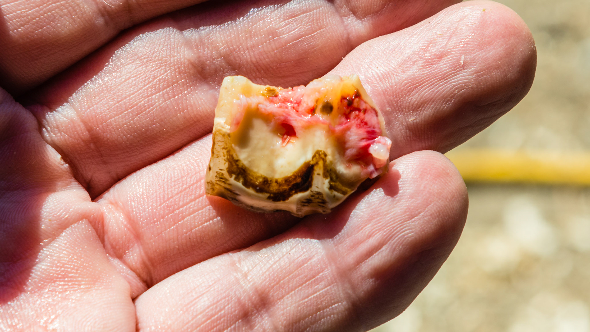 #208 buccal sagittal fracture seen removen in video 140908_extract fractured piece. The buccal side with gum attachment.