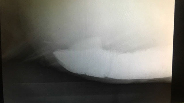 Radiographs showing sand in the colon.