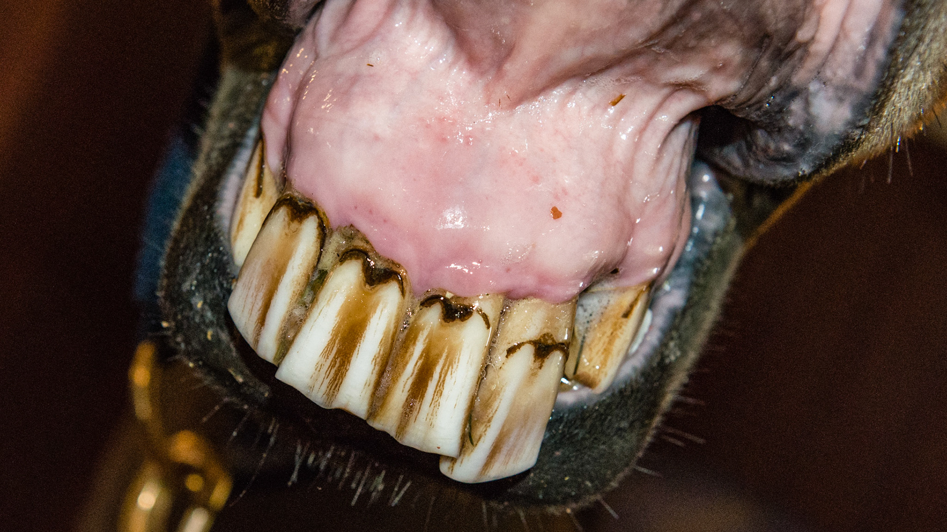 Avulsion fracture of the maxilla displacing the central upper incisors (101, 102, 201, 202). This fracture was allowed to heal without reduction into a normal position.  Age is unknown.