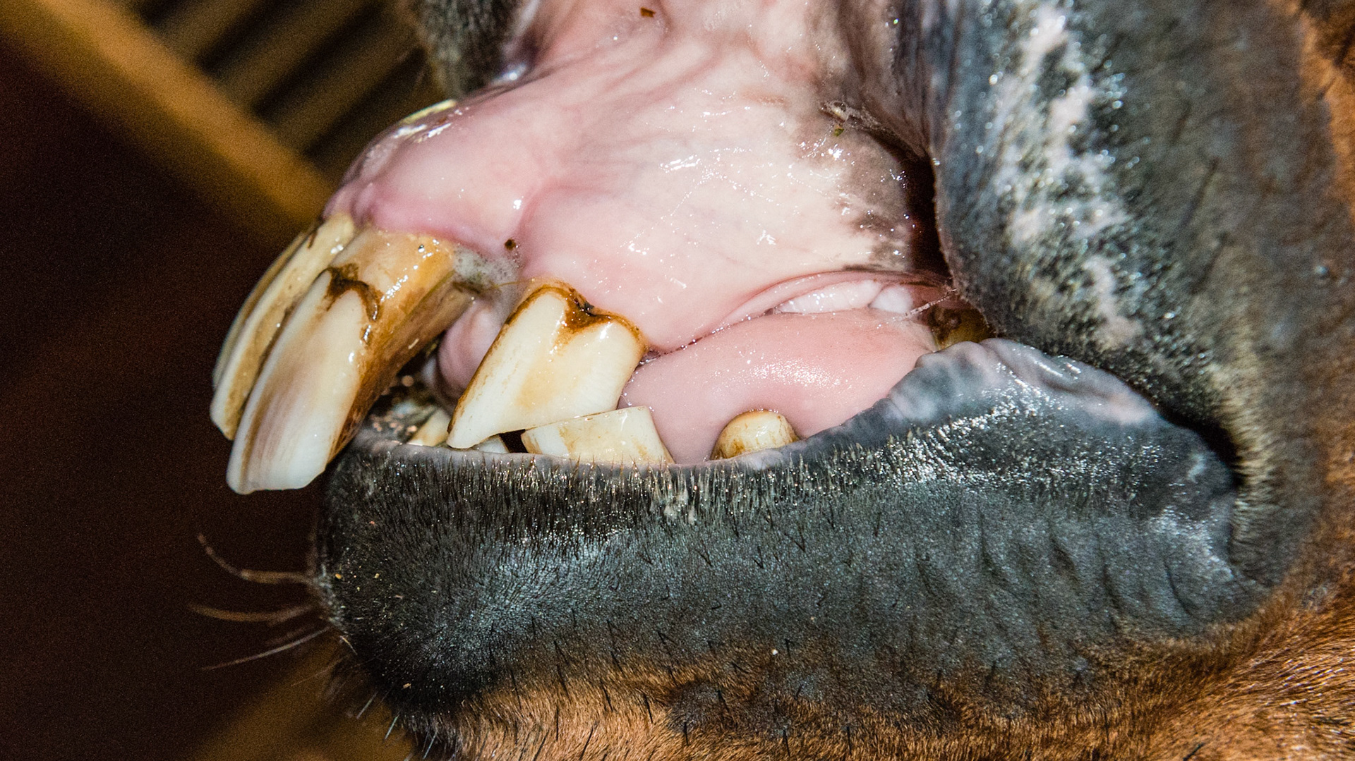 Avulsion fracture of the maxilla displacing the central upper incisors (101, 102, 201, 202). This fracture was allowed to heal without reduction into a normal position.  Age is unknown.