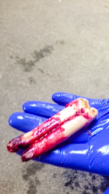 This is cheek tooth #409 or 408 extracted from a 7 year old Hanovarian mare.  There was a history of swelling followed eventually by drainage.  A few antibiotics were used and finally SMZ pills were settled on.  The owner tried this therapy for less than a month before she was talked into extraction.  I never saw this horse.  I believe that if she had waited several more months, this mare could have resolved this abscess, but owners do not want to wait or give antibiotics this long.