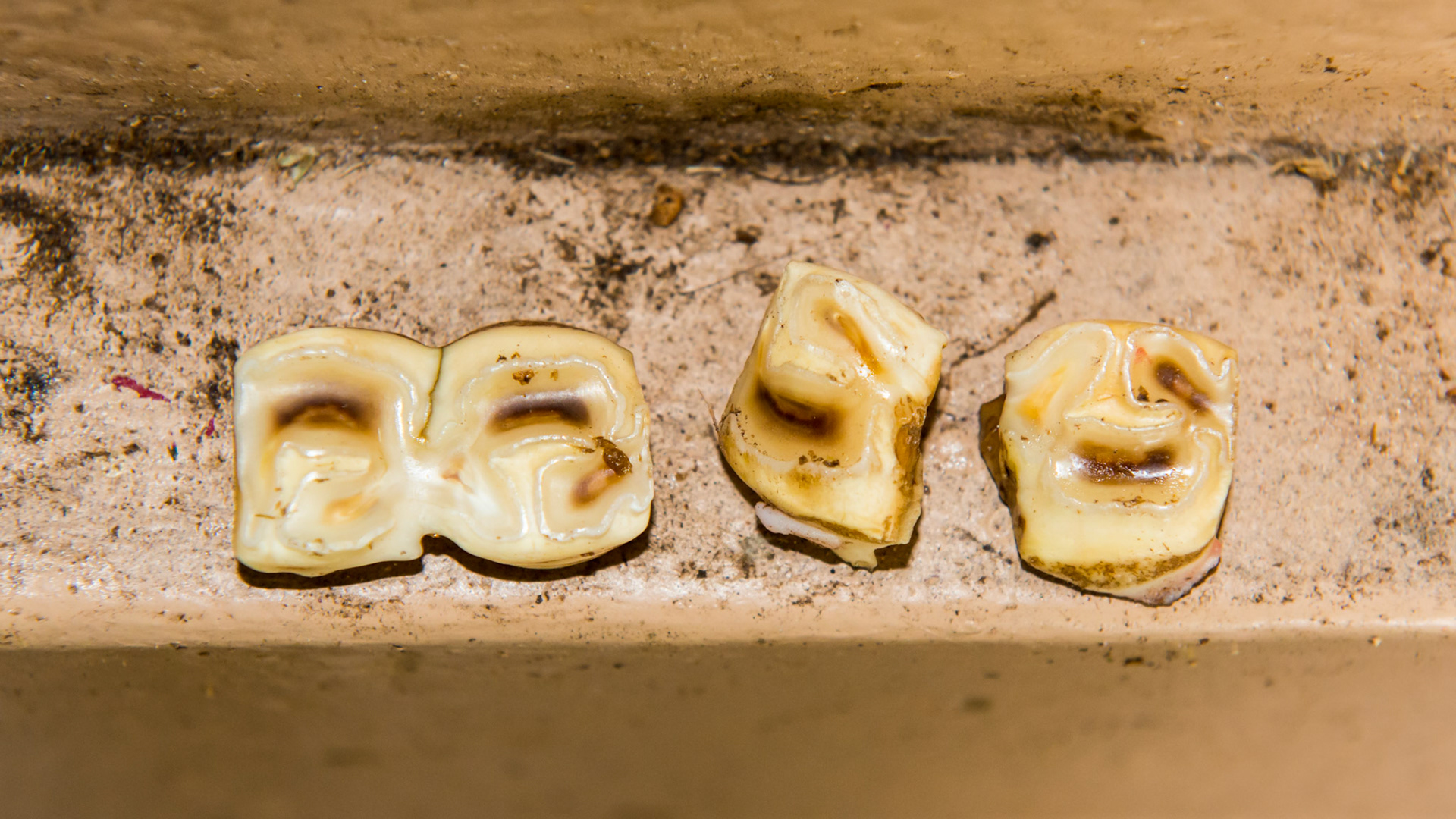 These are the #77 and 87 caps showing in one the occlusal surfaces and in the other,  the underlying surface with the green feed indicating the maturity of these caps.  #77 was split and was extracted in 2 pieces.  #87 has a fissure starting and would have cracked in two if left in the mouth.