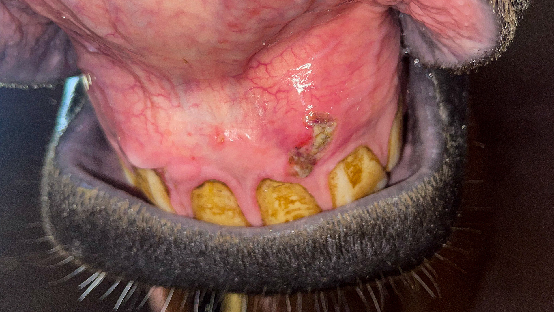 Hyperemic (reddened) gums with a traumatic gum lesion above the incisors. Also, mild signs of EOTRH.