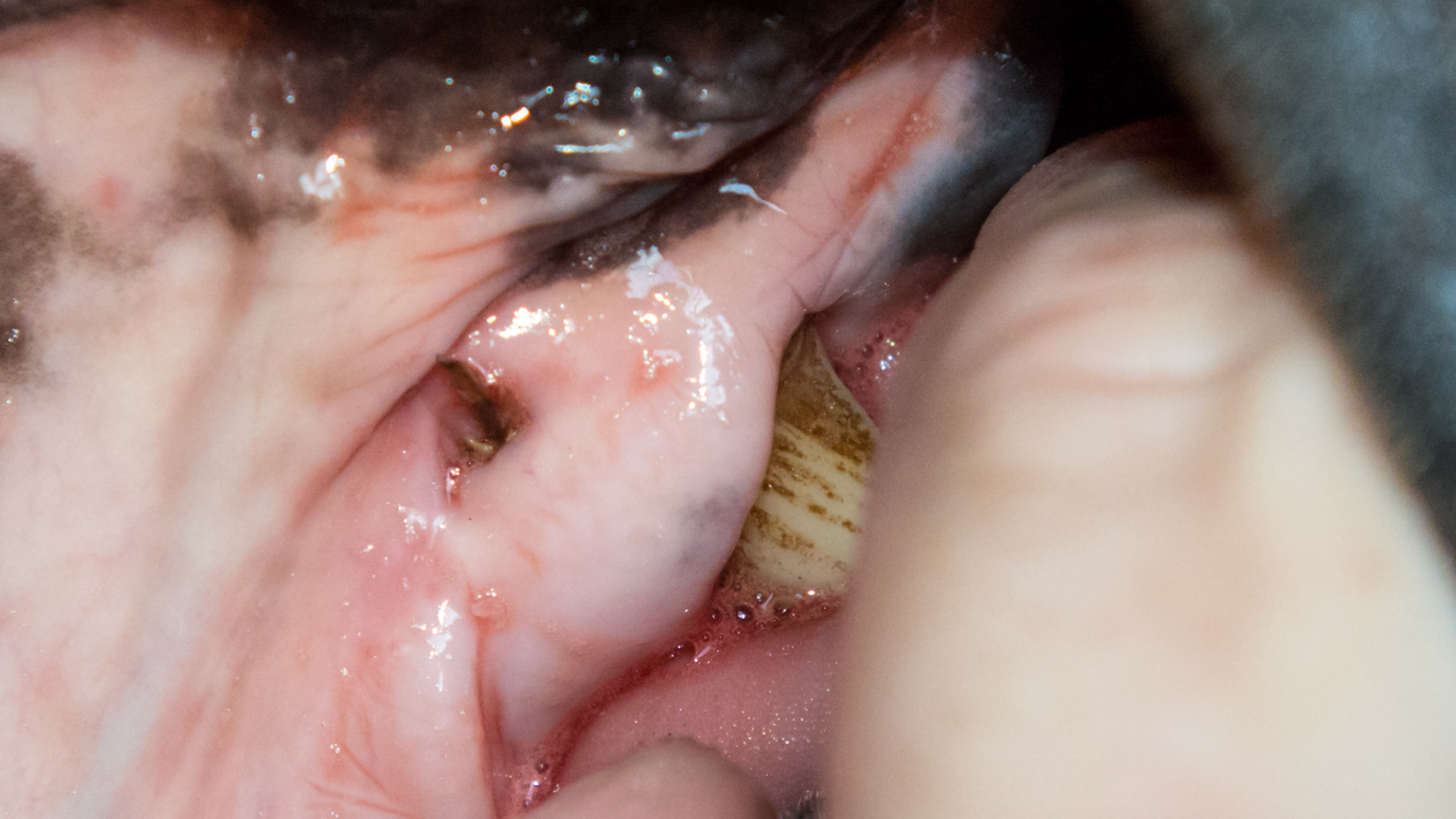 Hole - Small hole in gum above #205 where a foreign object was palpated.  It was non-painful. A second piece can be seen still in the hole.