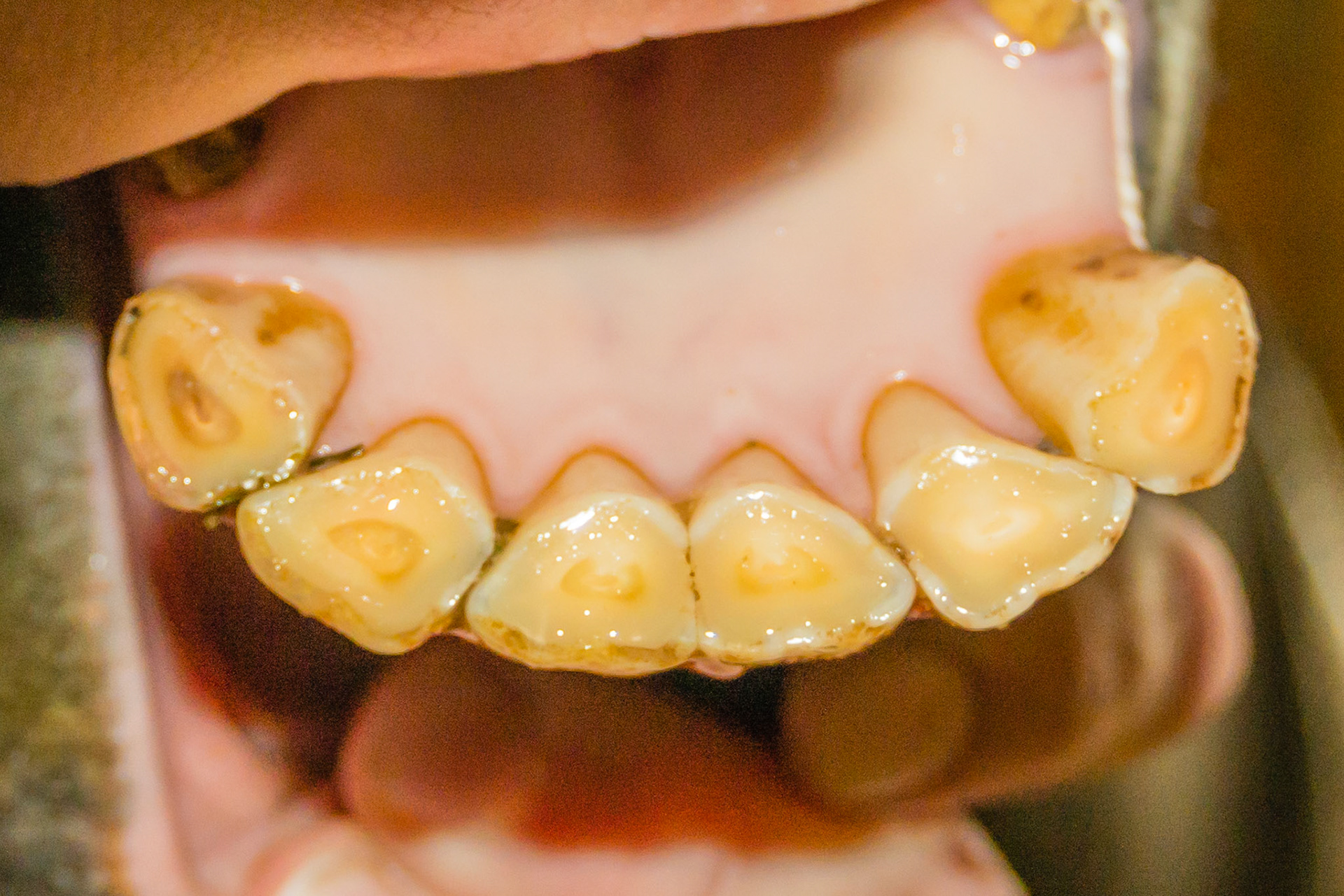 21yr 2mo - with relaxed incisors in a natural position