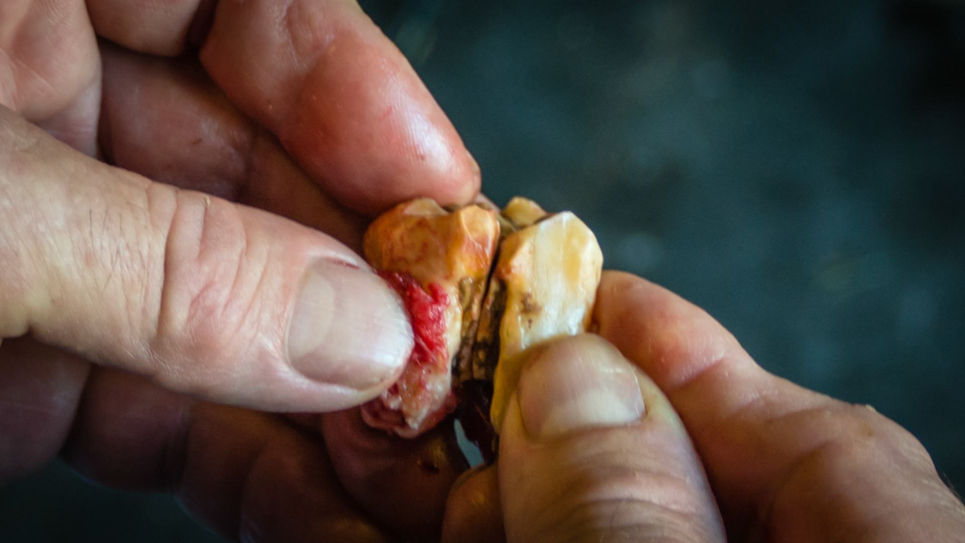 Cheek teeth fracture horse 1 -Fractured piece of 108 on caudal buccal surface was extracted. The remaining tooth and the neighboring 107 were unstable due to age (27 yr, end stage teeth) and were also removed with little effort.