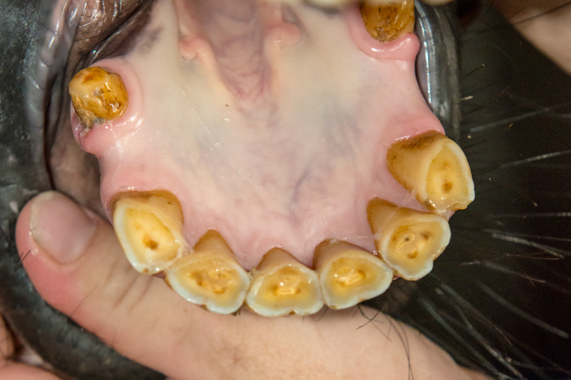 16yr 5mo - Early stage of EOTRH with thickening of the gums around the canines, #404 early necrosis, bulbous appearance of incisors. No pain of difficulty in using incisors.