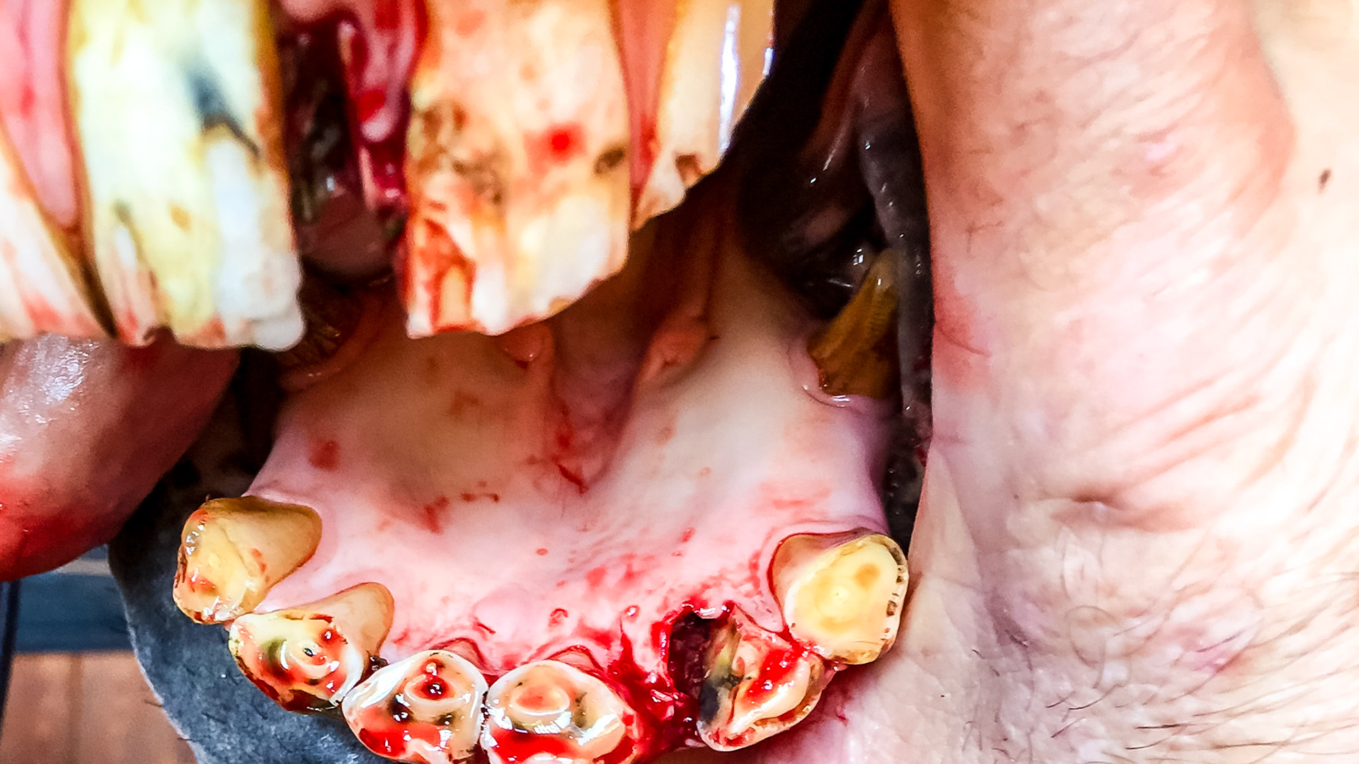 Incisor fracture horse - The upper 202 and the lower 302 incisors are both fractured in this horse. Cause is unknown but trauma is suspected. This series shows the before and after removal of the dead pieces of tooth with various views of the extracted pieces.