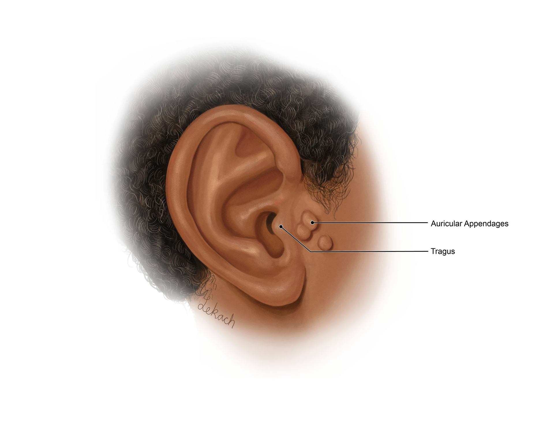 Supernumerary Ears - St. George's University