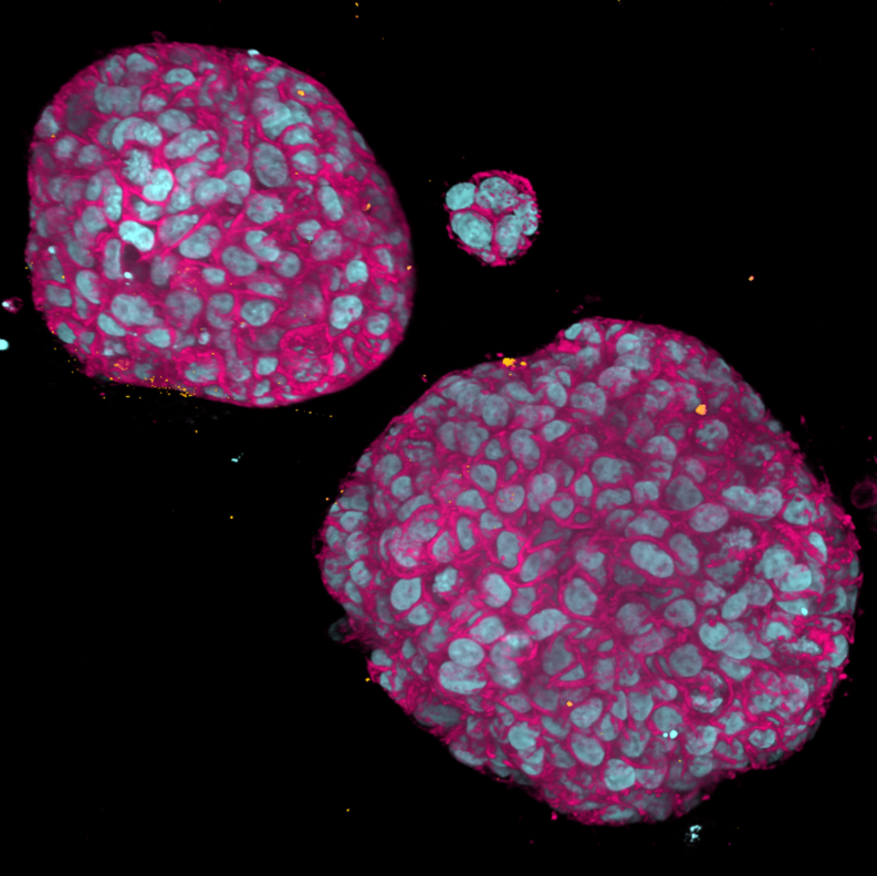 3D Colorectal Cancer Spheroids
