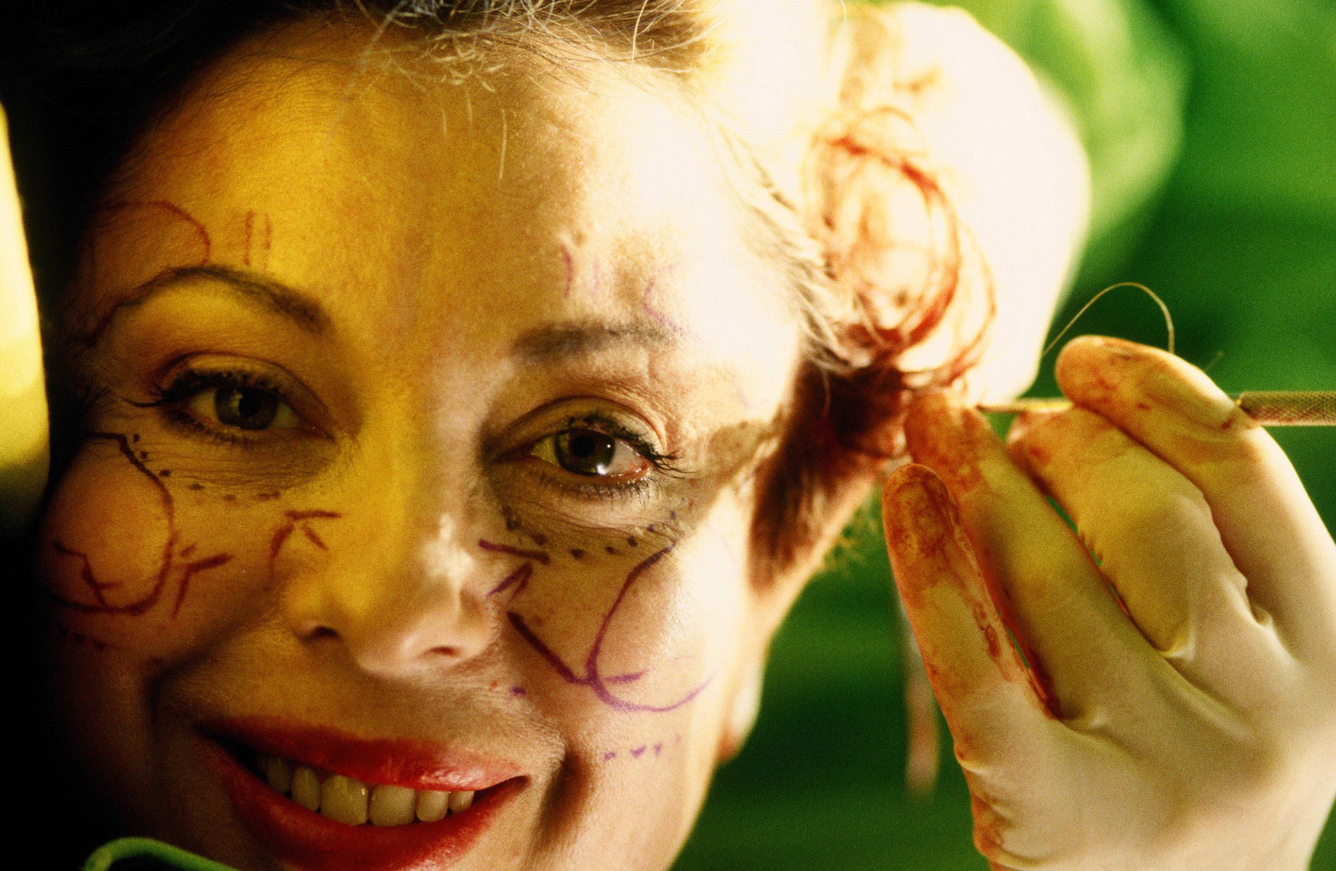 Orlan: Omnipresence – Surgery, 1993