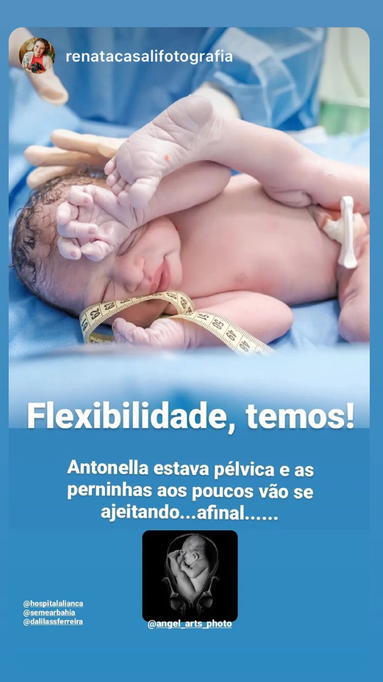 my breech birth image is most favourite between midwifes world wide