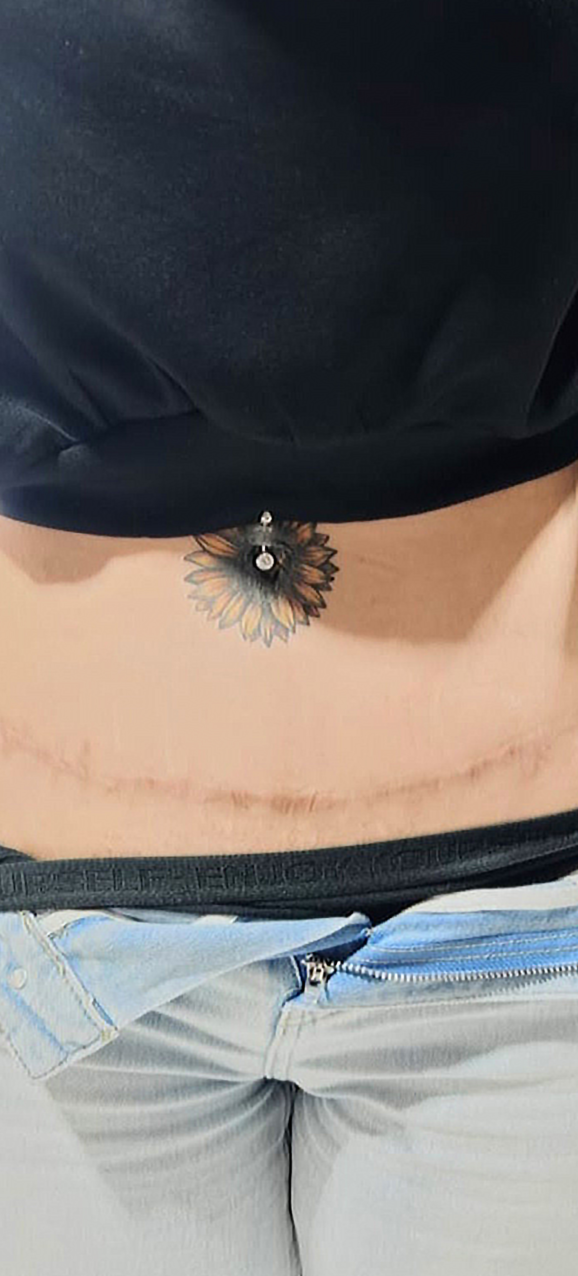 Scar tissue Cover-up Before
