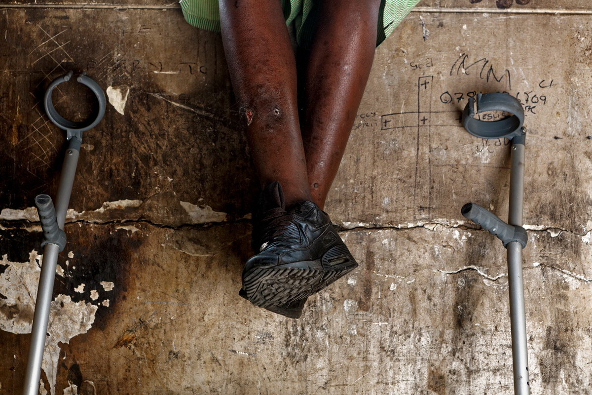 Gun Shot 2014 - 2016 Photographic Print Fine Art Cotton Rag A1. A young Zimbabwean man sits on a wall in Dark City with a bullet wound through his leg. During an interview he said he was shot in crossfire by the police and wouldn't get medical attention due to fear of being deported.