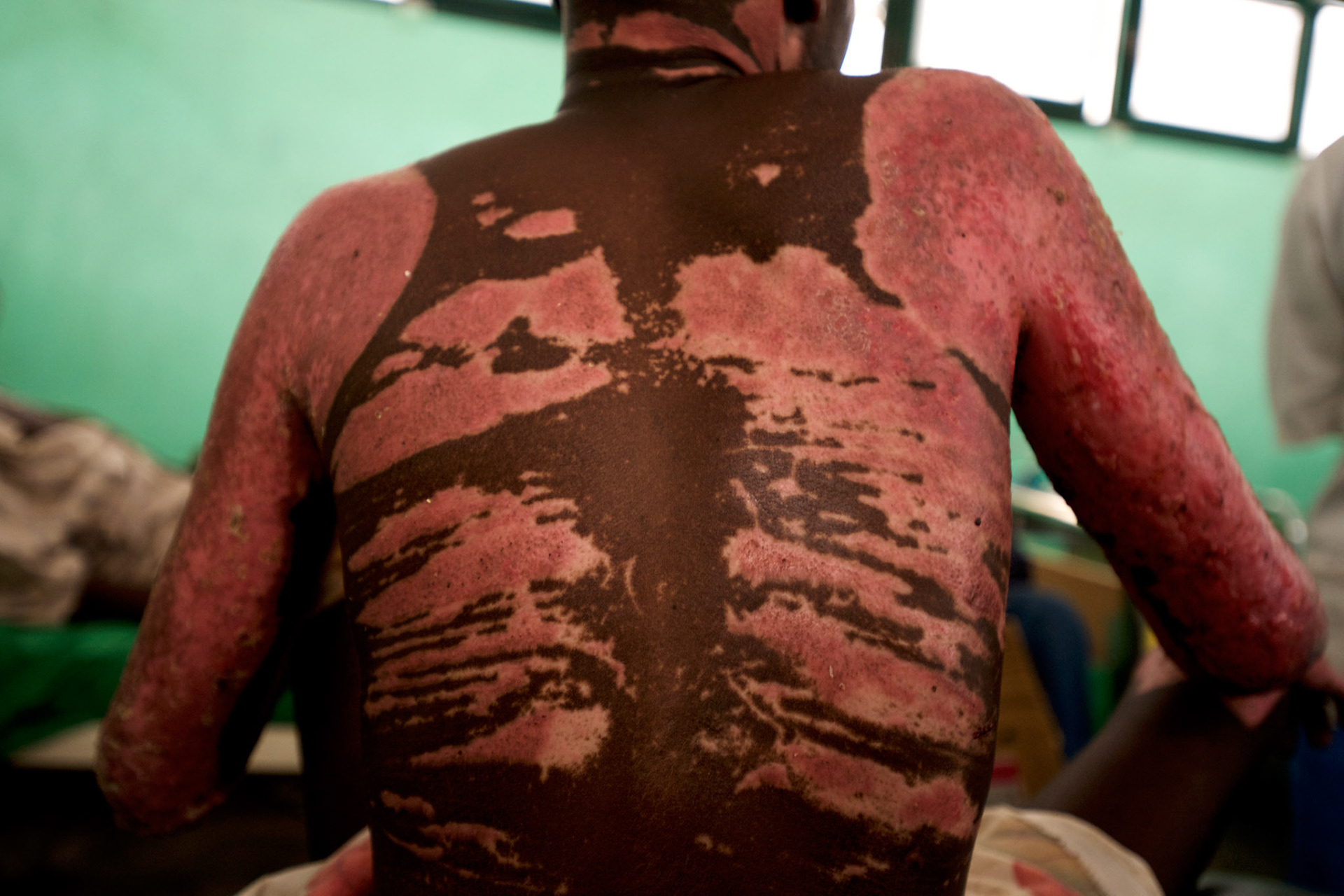 Detail view of the burned back of a Sudan People’s Liberation Movement (SPLA-N) rebel soldier being treated at an hospital in Gidel village. The fighter was severely wounded as a result of a bomb dropped by the Sudanese airforce in the rebel-held territory of the Nuba Mountains in South Kordofan.