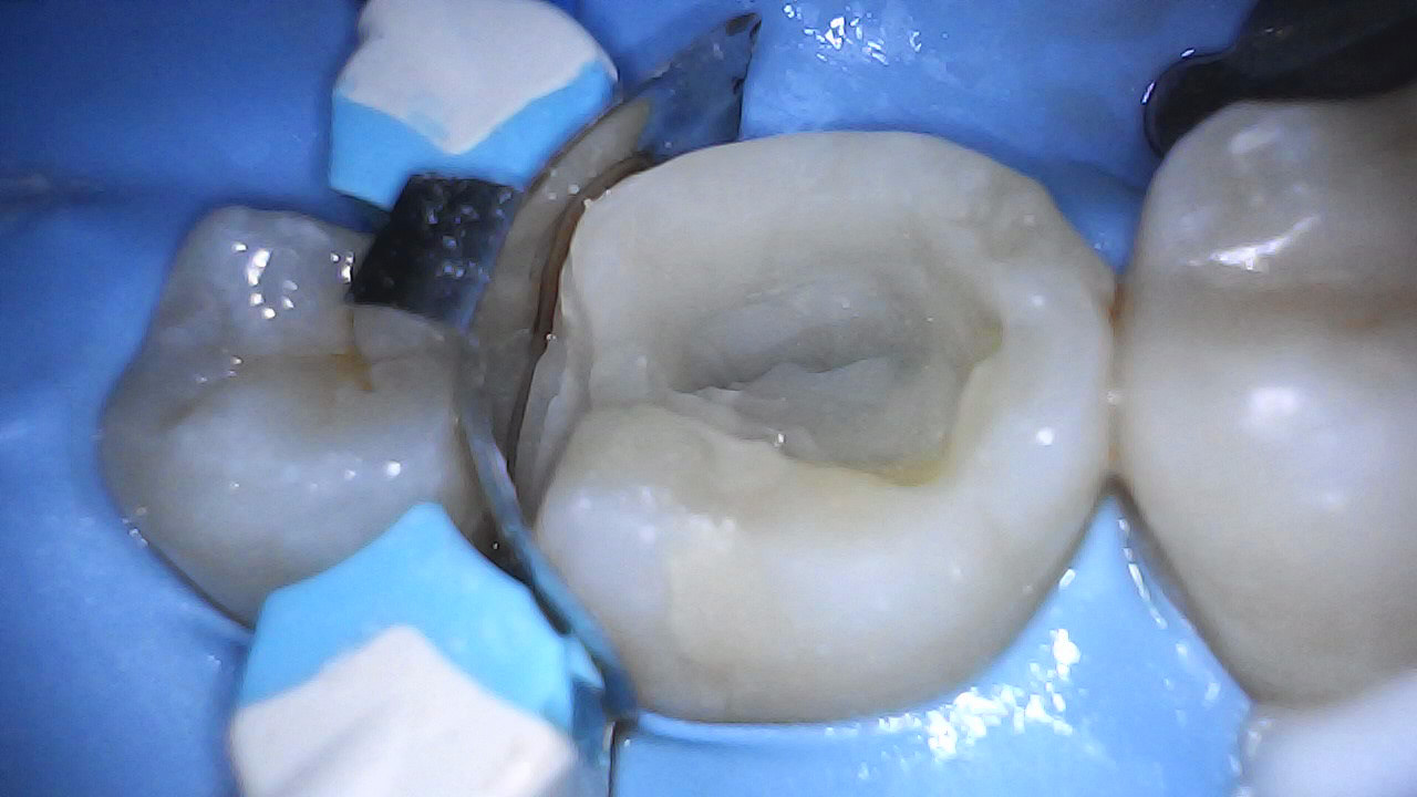 Temp fuji replacement with Ga-enial injectable A2, Ever X posterior & Filtek XT A2B