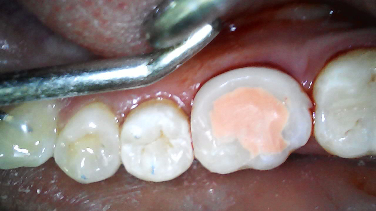 36 restores temporarily with Filtek Supreme A2B. Fuji VII to monitor pulp response 3 months