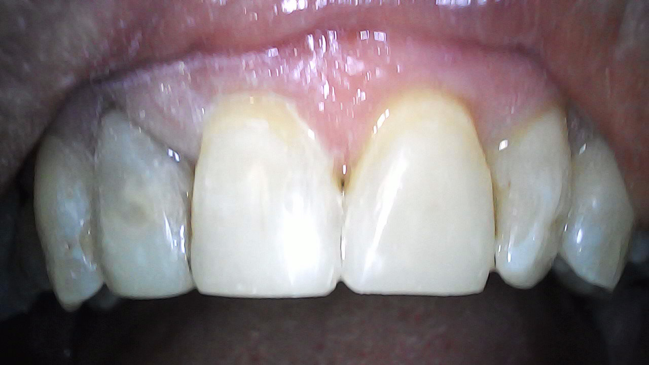 Restored with Filtek XT A3B