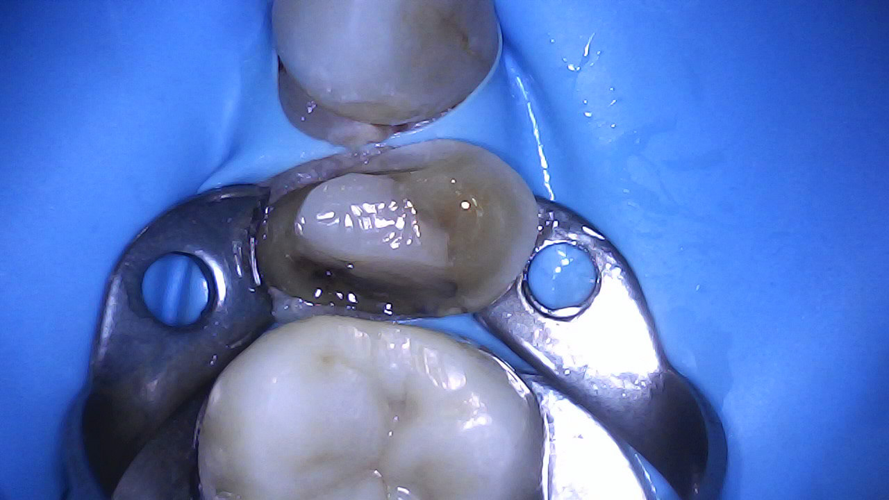 Tooth prep and IDS