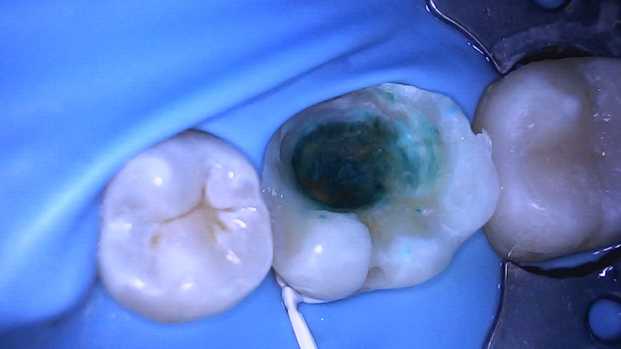 Selective caries removal with help from caries dye