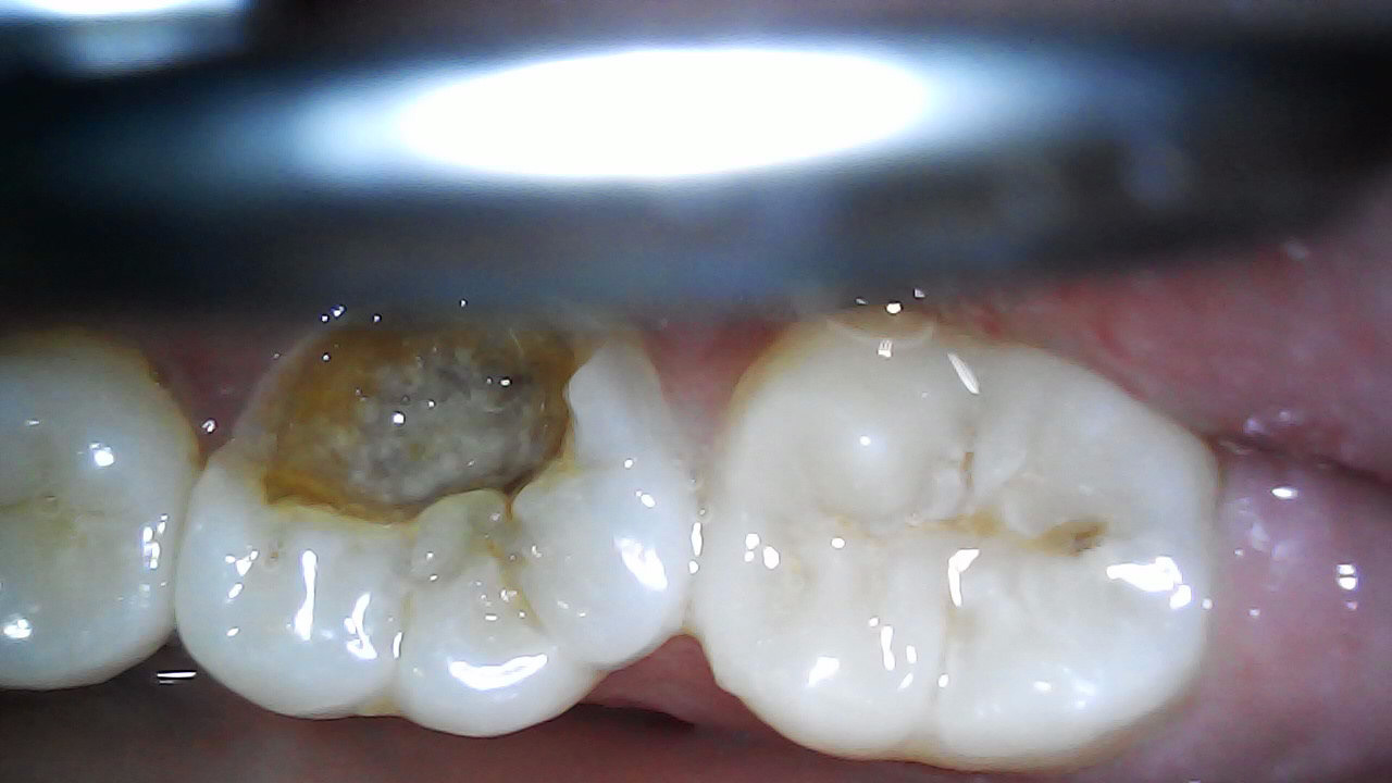 36 NTTP, Cold +ve, vital. 37 O caries