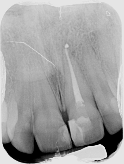 6 MONTHS FOLLOW-UP
