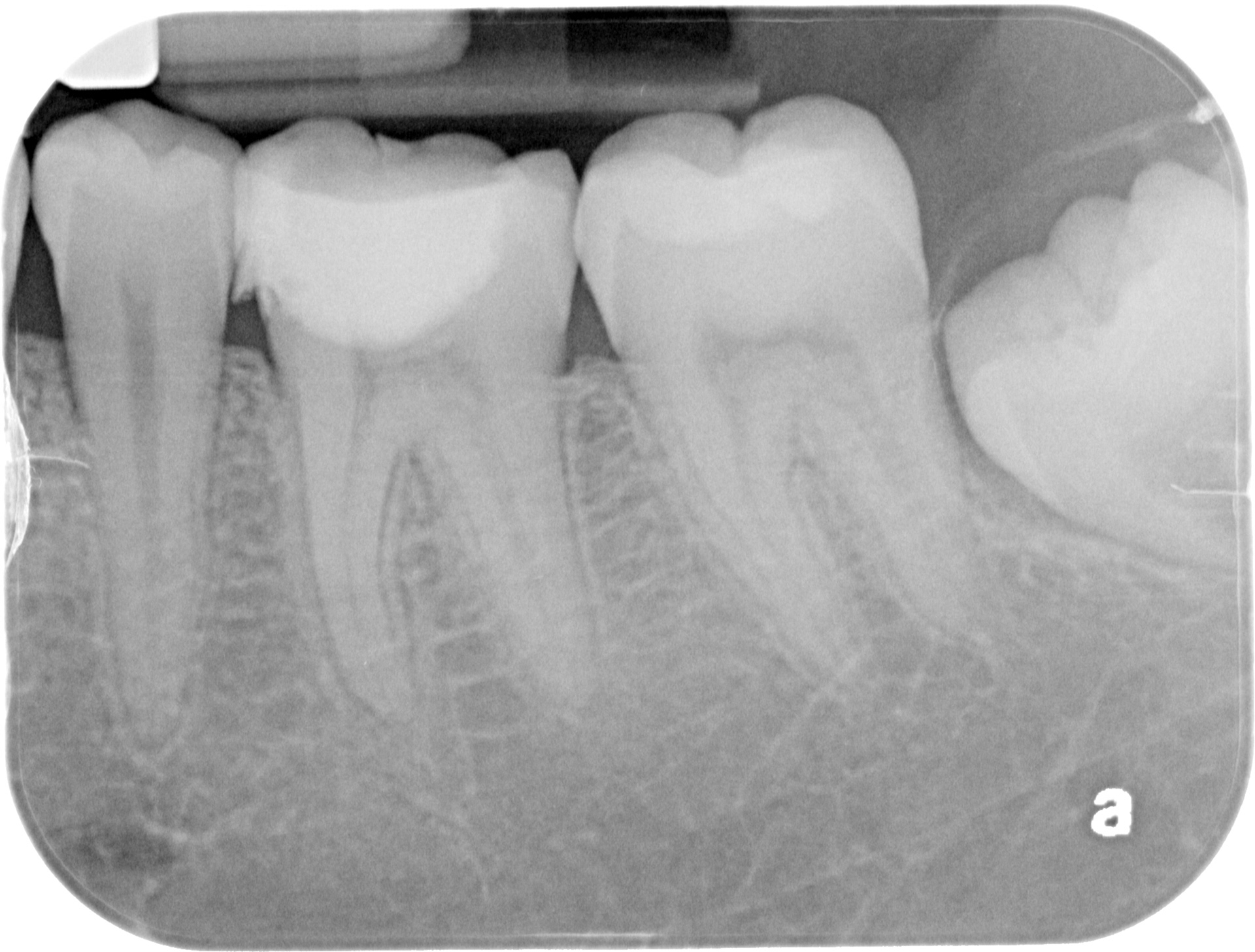 3 months later - Pulp remained vital, tooth asymptomatic (mesial overhang removed)