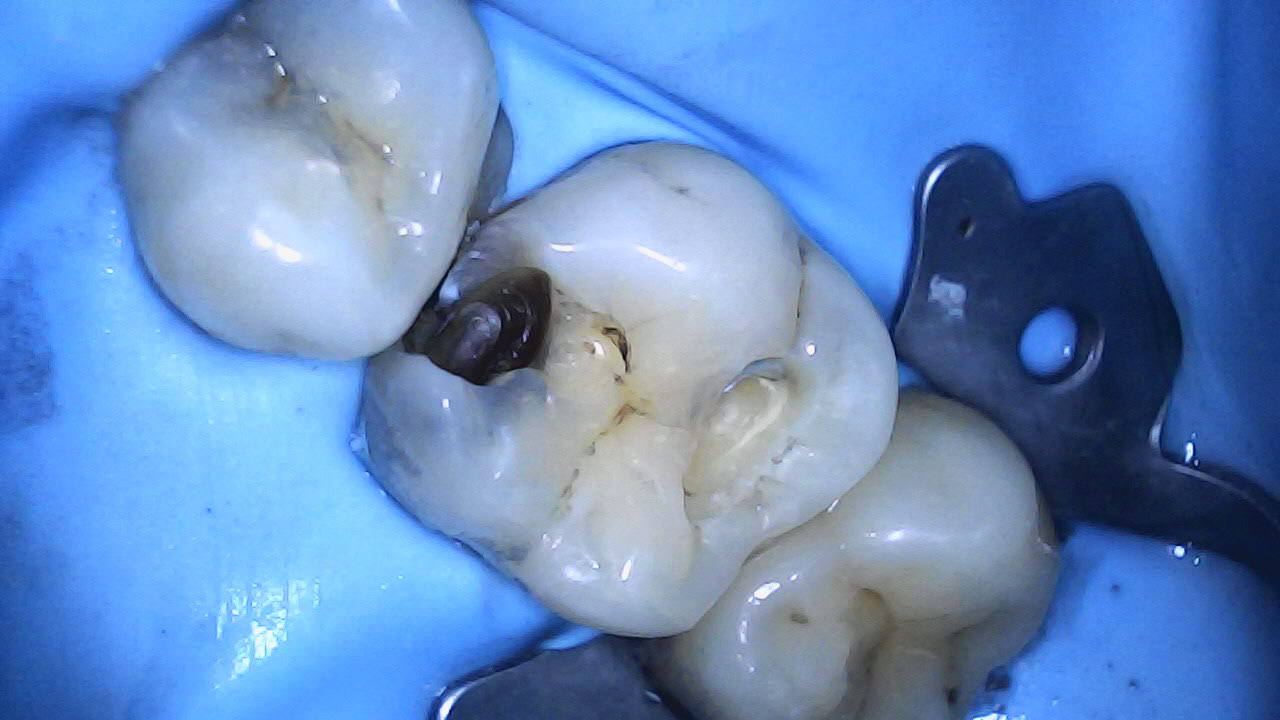 Amalgam + caries removal