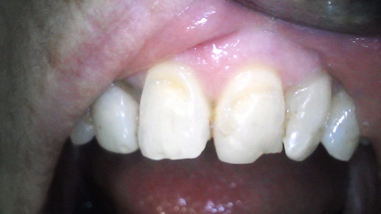 Enamel fractures and abrasion lesions